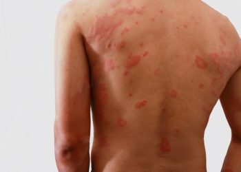 Janeiro Roxo: Canaã inicia ações de prevenção à hanseníase nesta quinta (19)