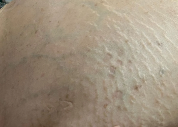 Morre mulher que teve tumor de 46 kg retirado em cirurgia de emergência