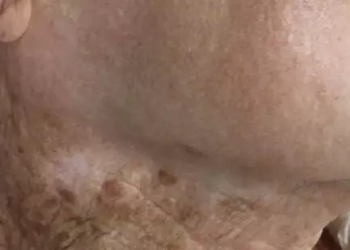 Foto de idosa que passava protetor solar no rosto, mas não no pescoço, surpreende a web